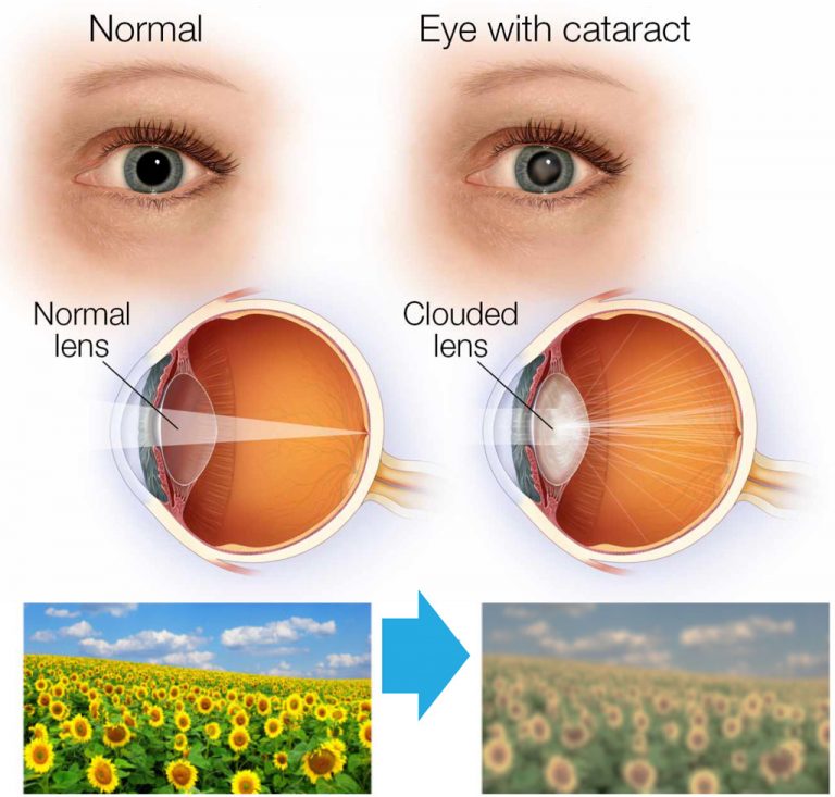 Cataract Surgery in Ambikapur