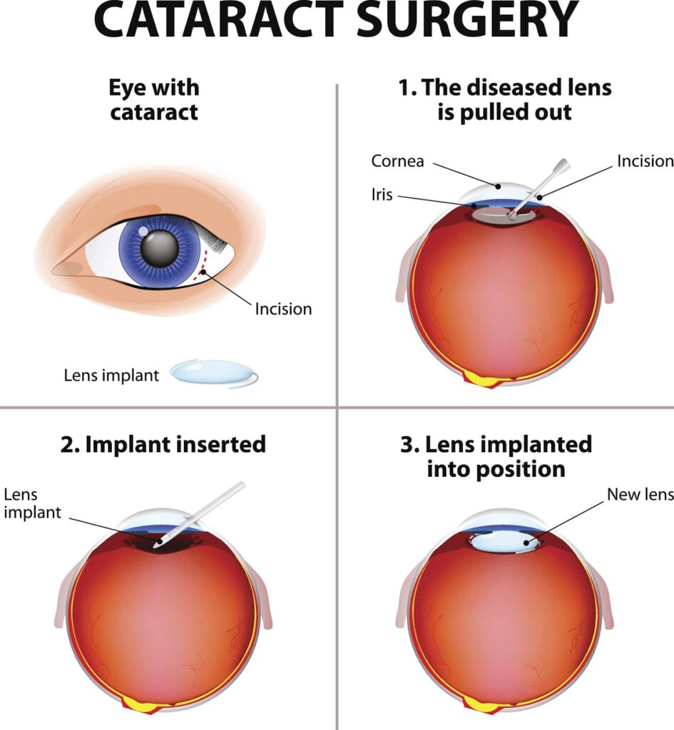 Best Cataract surgery in Ambikapur?